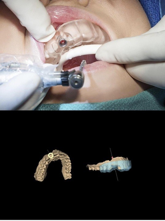 Точные, хирургические шаблоны для стоматологии, изготавливаемые на заказ