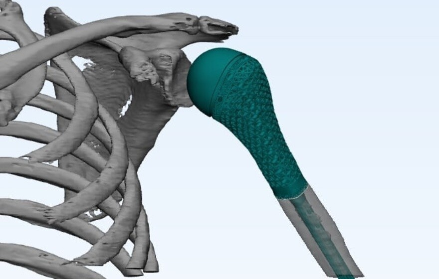 На российском рынке появился 3D-печатный имплантат плечевого сустава с модифицированной поверхностью