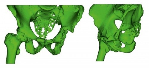 Технологические особенности и опыт 3D-печати индивидуальных медицинских изделий