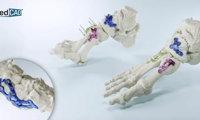 AccuStride_MedCAD_FDA_510k_3D_printed_guides